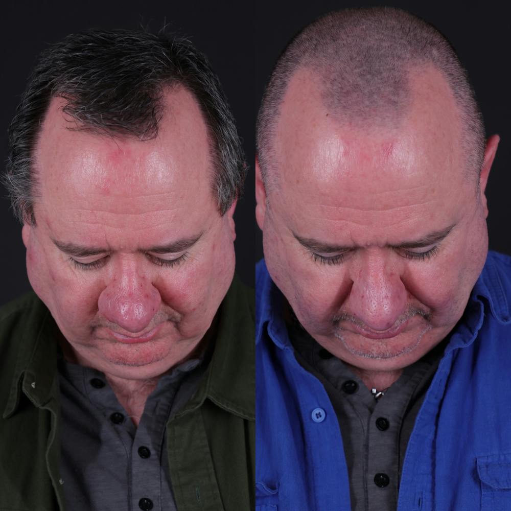 Rhinophyma Before & After Gallery - Patient 203411 - Image 4