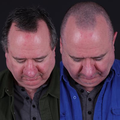 Rhinophyma Before & After Gallery - Patient 203411 - Image 4
