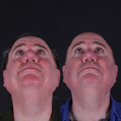 Rhinophyma Before & After Gallery - Patient 203411 - Image 2