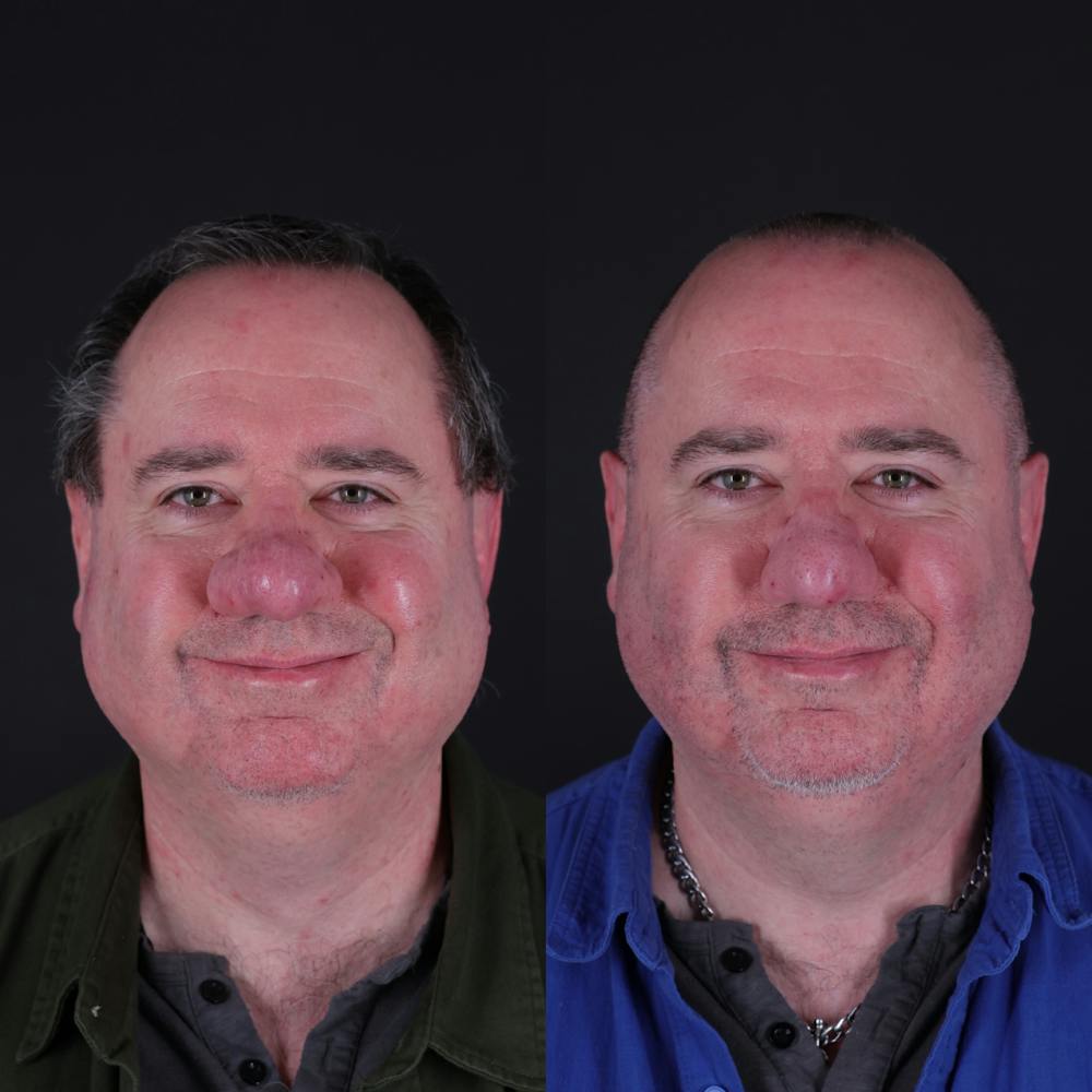 Rhinophyma Before & After Gallery - Patient 203411 - Image 3