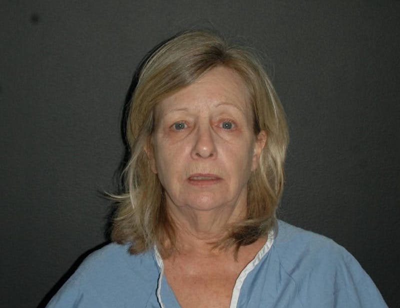 Brow Lift Before & After Gallery - Patient 823631 - Image 1