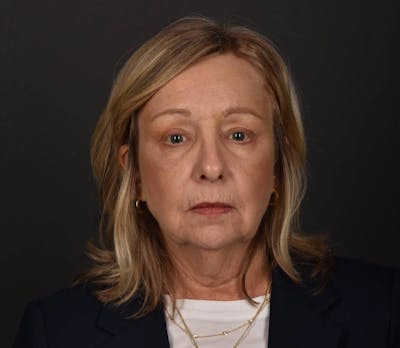 Brow Lift Before & After Gallery - Patient 823631 - Image 2