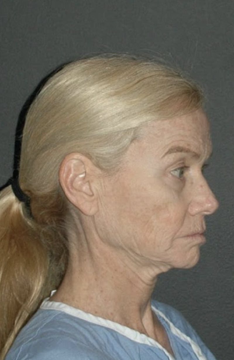 Brow Lift Before & After Gallery - Patient 793174 - Image 3