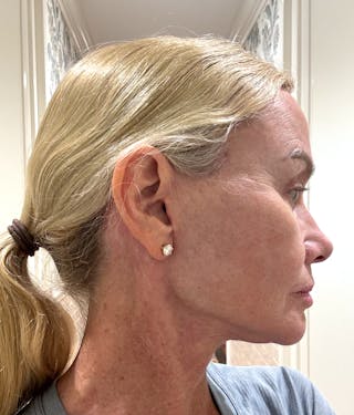 Deep Plane Facelift Before & After Gallery - Patient 140352 - Image 4