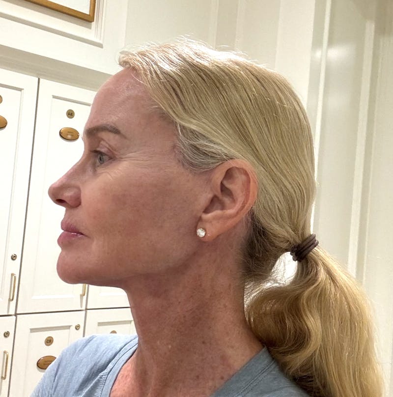 Brow Lift Before & After Gallery - Patient 793174 - Image 6
