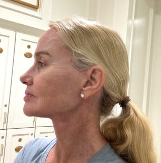 Deep Plane Facelift Before & After Gallery - Patient 140352 - Image 6