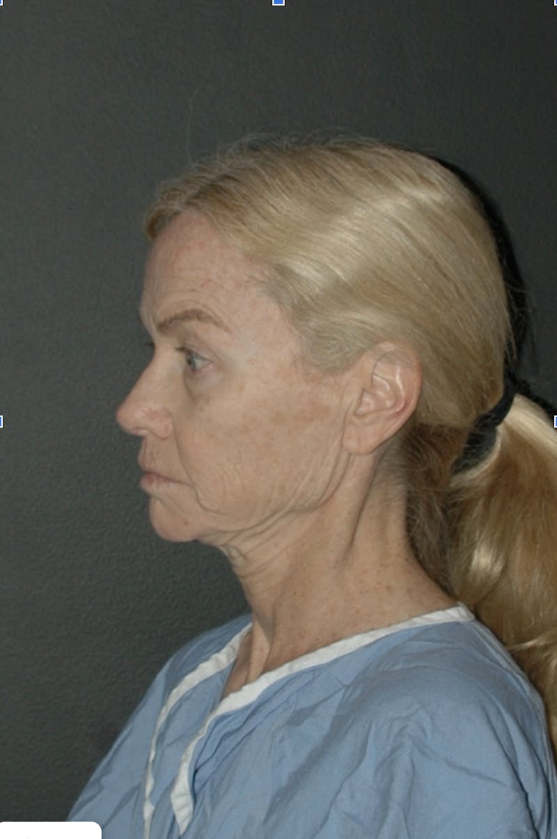 Brow Lift Before & After Gallery - Patient 793174 - Image 5