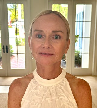 Deep Plane Facelift Before & After Gallery - Patient 140352 - Image 2