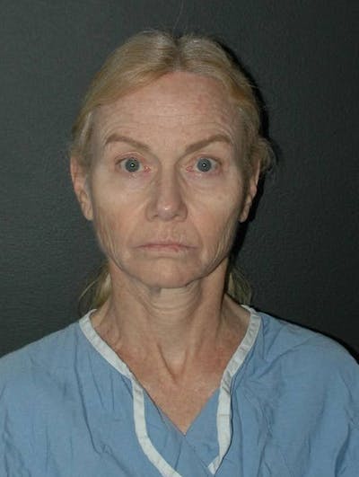 Brow Lift Before & After Gallery - Patient 793174 - Image 1