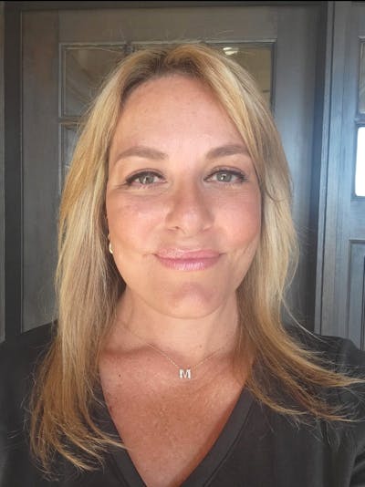 Brow Lift Before & After Gallery - Patient 267756 - Image 2