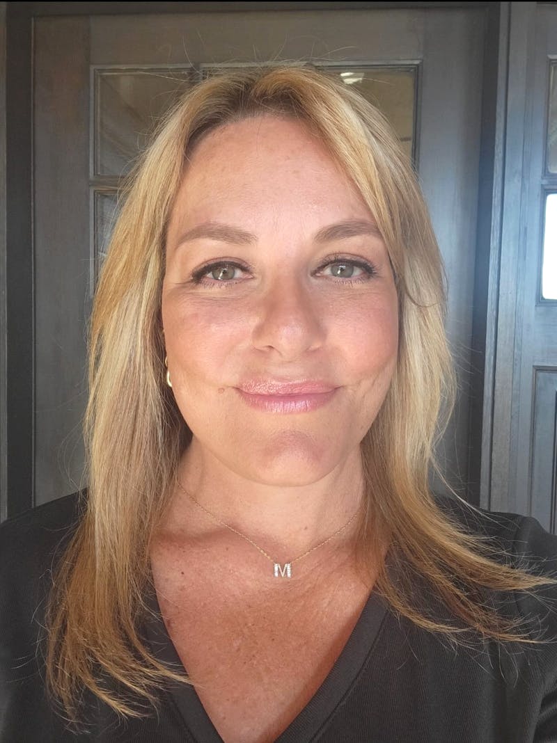 Brow Lift Before & After Gallery - Patient 267756 - Image 2