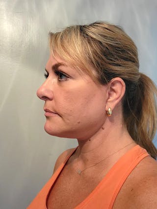 Deep Plane Facelift Before & After Gallery - Patient 281148 - Image 4