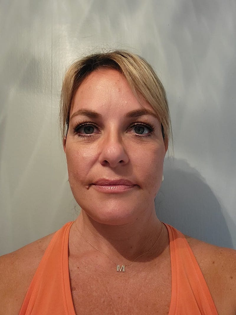 Brow Lift Before & After Gallery - Patient 267756 - Image 6