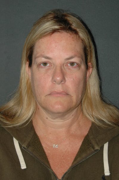 Brow Lift Before & After Gallery - Patient 267756 - Image 1