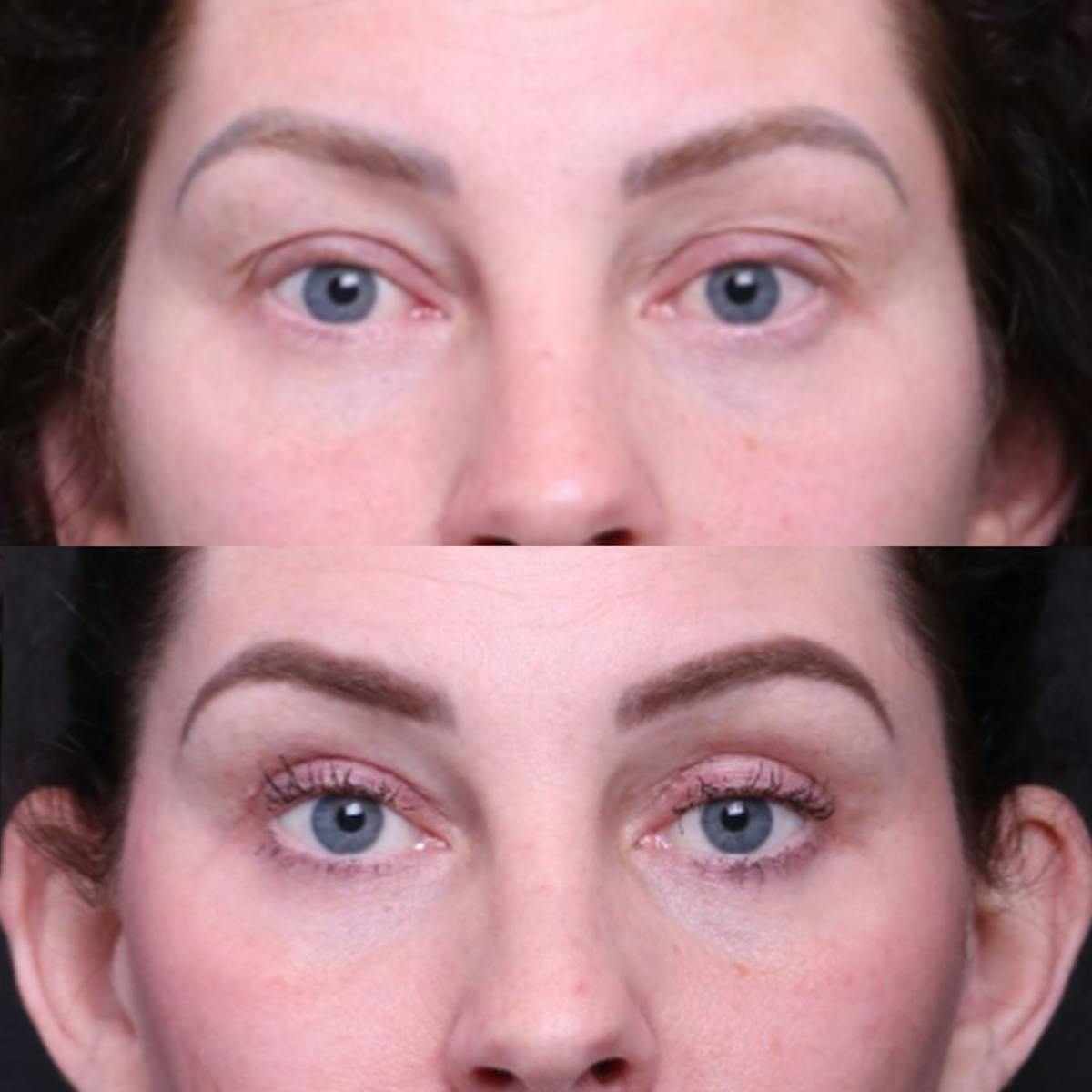 Blepharoplasty Before & After Gallery - Patient 276391 - Image 1
