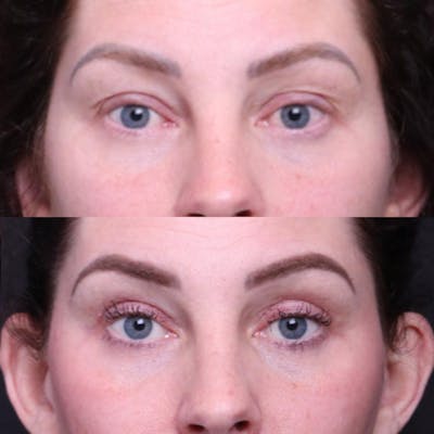Blepharoplasty Before & After Gallery - Patient 276391 - Image 1