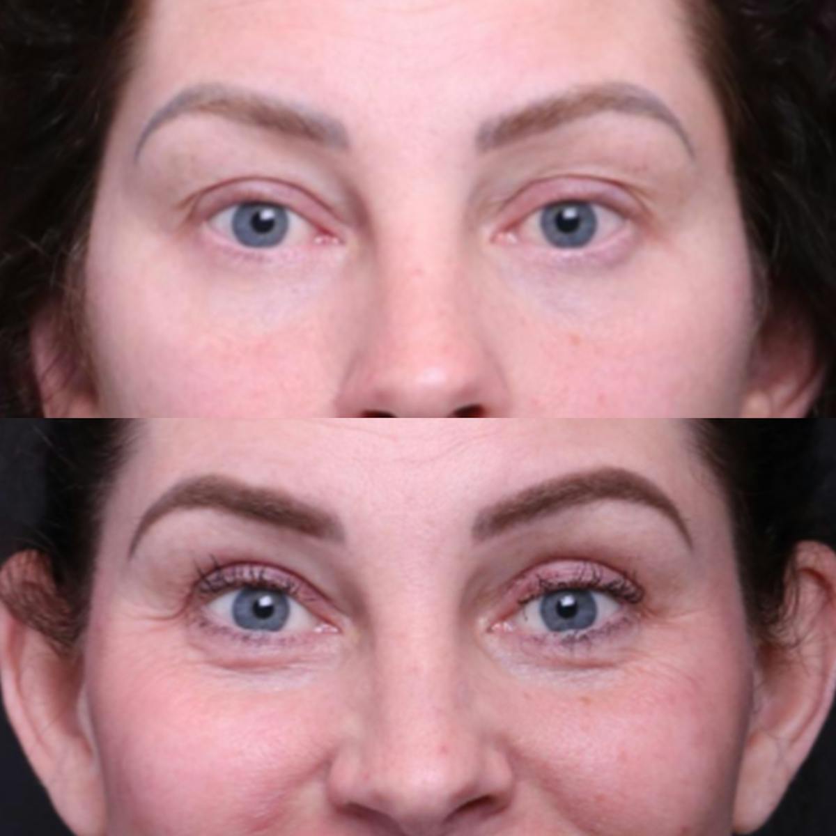 Blepharoplasty Before & After Gallery - Patient 276391 - Image 2
