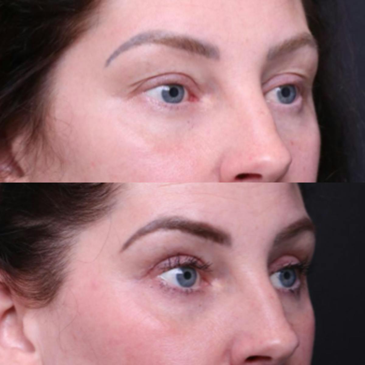 Blepharoplasty Before & After Gallery - Patient 276391 - Image 3