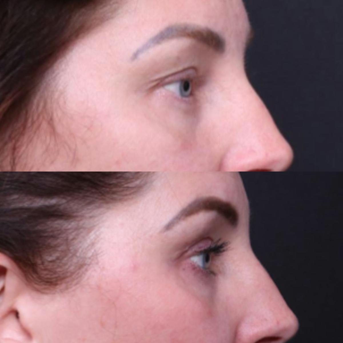 Blepharoplasty Before & After Gallery - Patient 276391 - Image 4