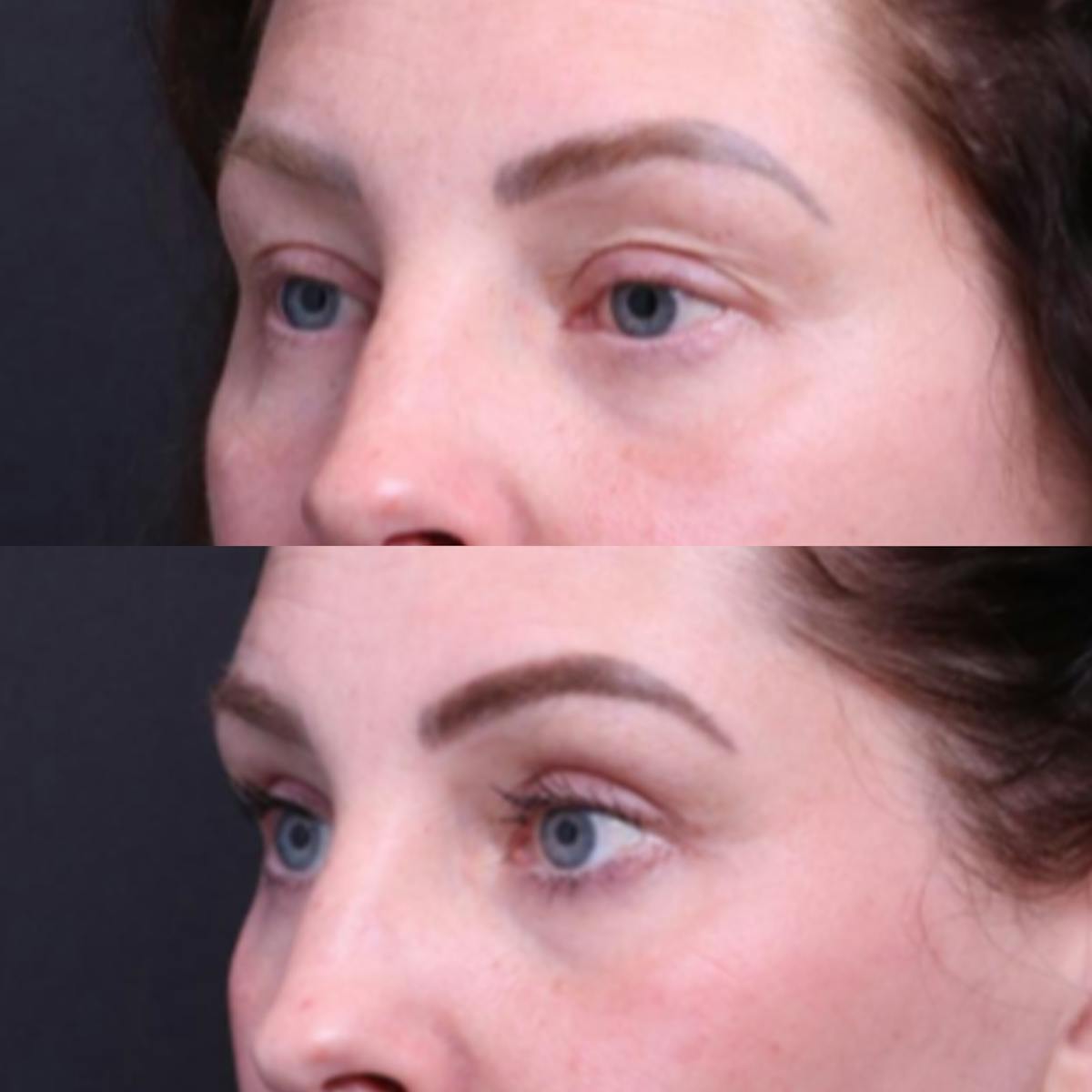 Blepharoplasty Before & After Gallery - Patient 276391 - Image 6