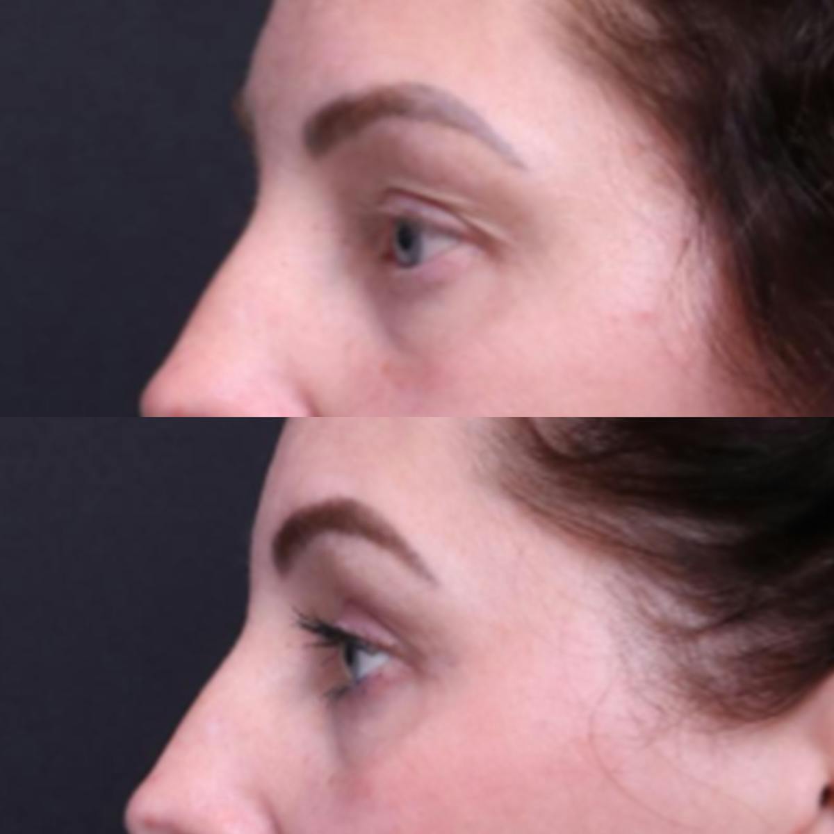 Blepharoplasty Before & After Gallery - Patient 276391 - Image 5