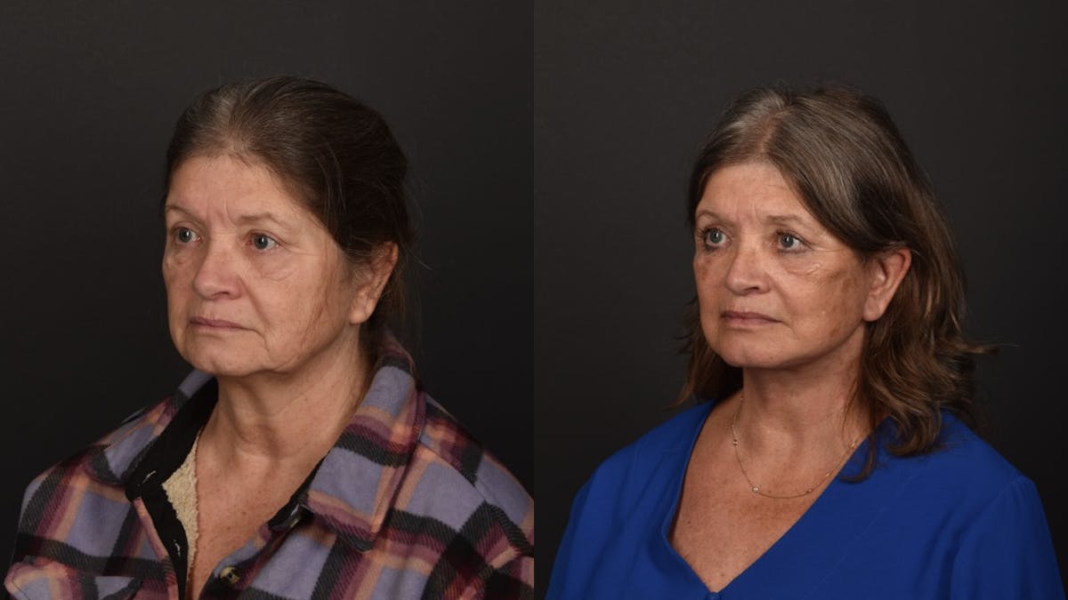 Deep Plane Facelift Before & After Gallery - Patient 252824 - Image 7