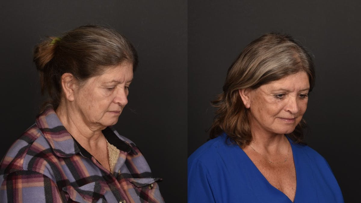 Deep Plane Facelift Before & After Gallery - Patient 252824 - Image 4