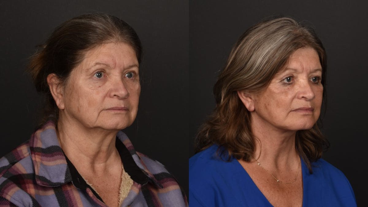 Deep Plane Facelift Before & After Gallery - Patient 252824 - Image 3