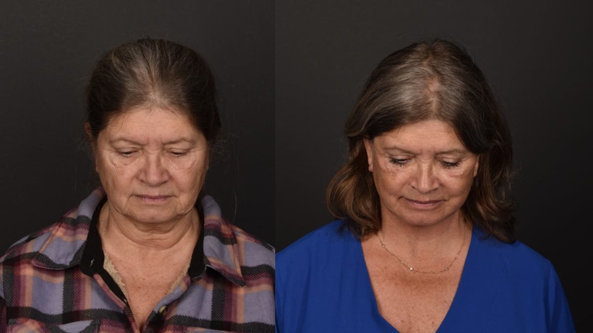 Deep Plane Facelift Before & After Gallery - Patient 252824 - Image 2