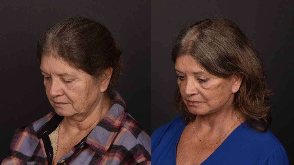 Deep Plane Facelift Before & After Gallery - Patient 252824 - Image 8
