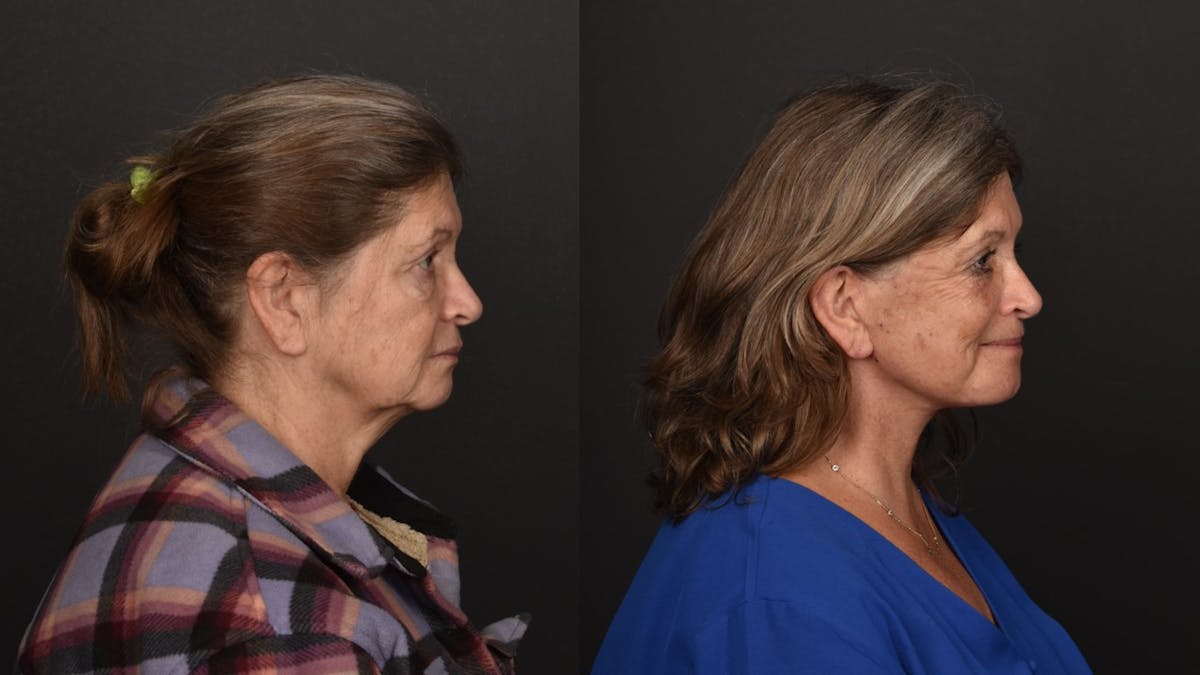 Deep Plane Facelift Before & After Gallery - Patient 252824 - Image 5