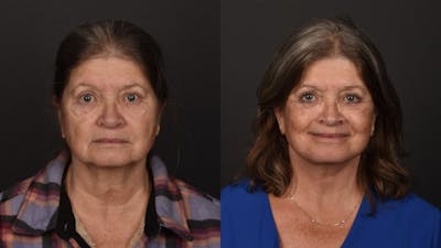 Deep Plane Facelift Before & After Gallery - Patient 252824 - Image 1