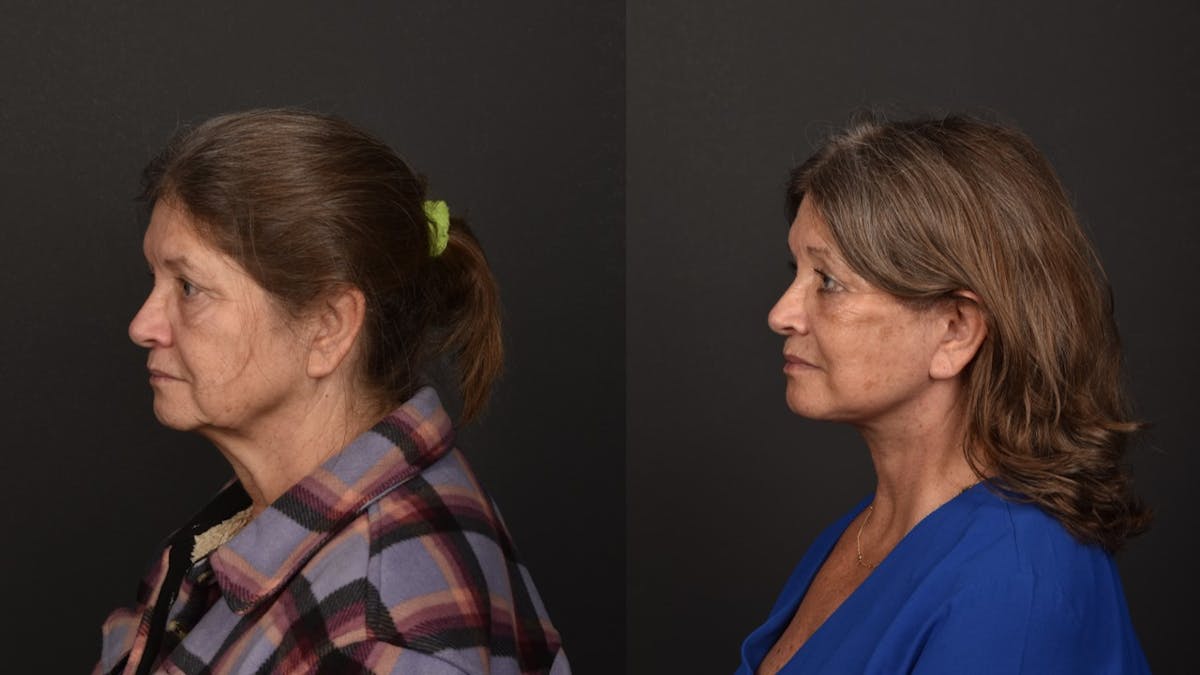 Deep Plane Facelift Before & After Gallery - Patient 252824 - Image 6