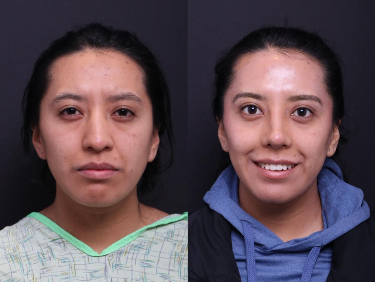 Rhinoplasty Before & After Gallery - Patient 372630 - Image 2