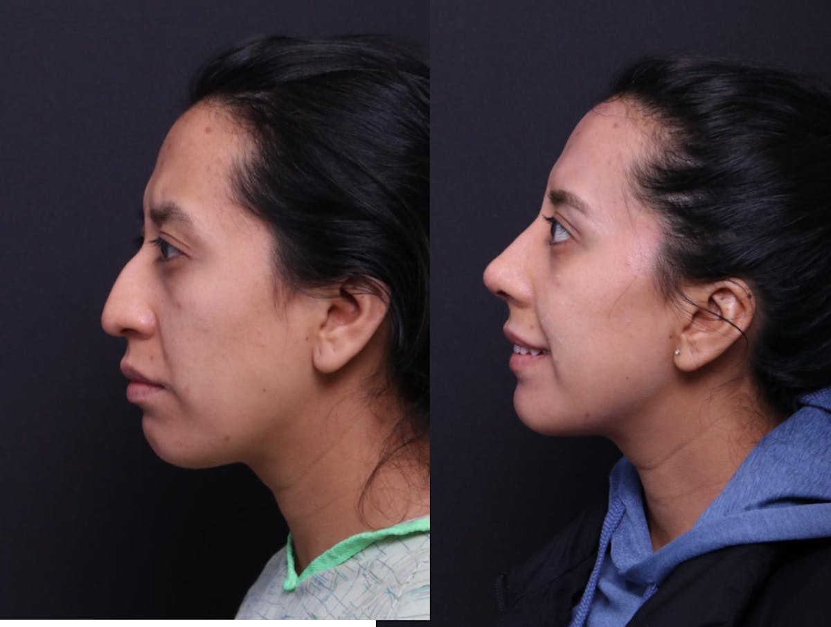 Rhinoplasty Before & After Gallery - Patient 372630 - Image 5