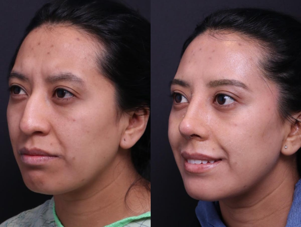 Rhinoplasty Before & After Gallery - Patient 372630 - Image 6