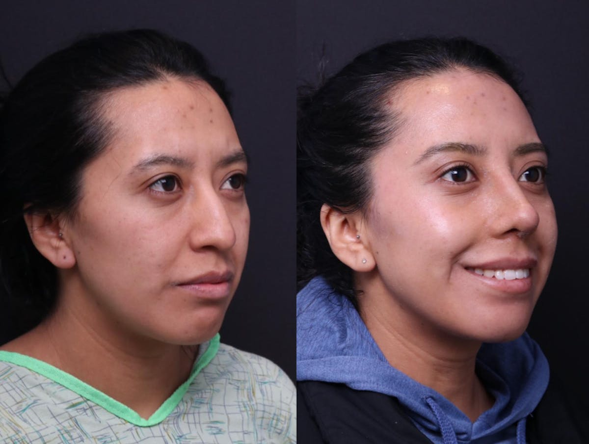 Rhinoplasty Before & After Gallery - Patient 372630 - Image 3