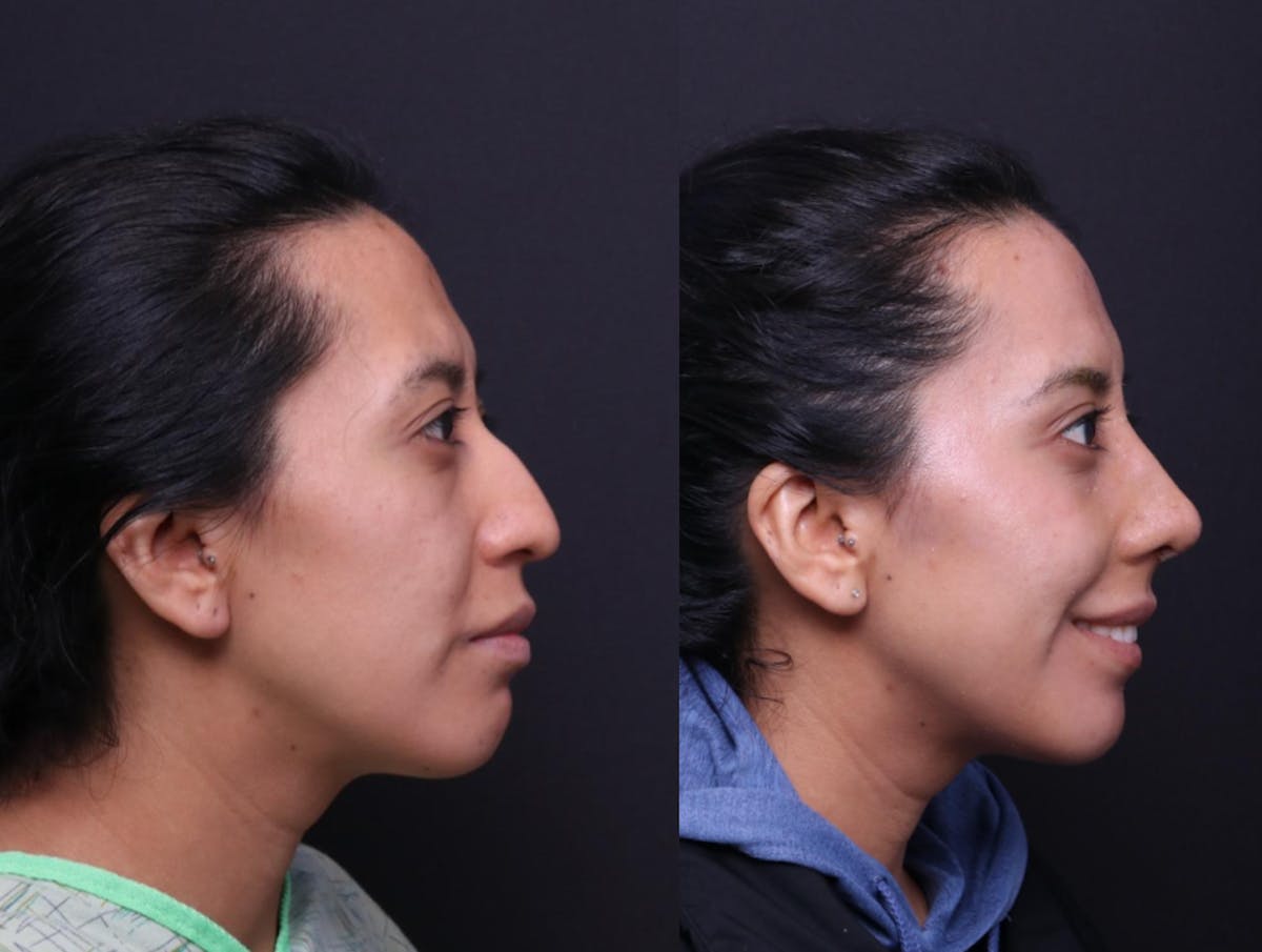 Rhinoplasty Before & After Gallery - Patient 372630 - Image 4