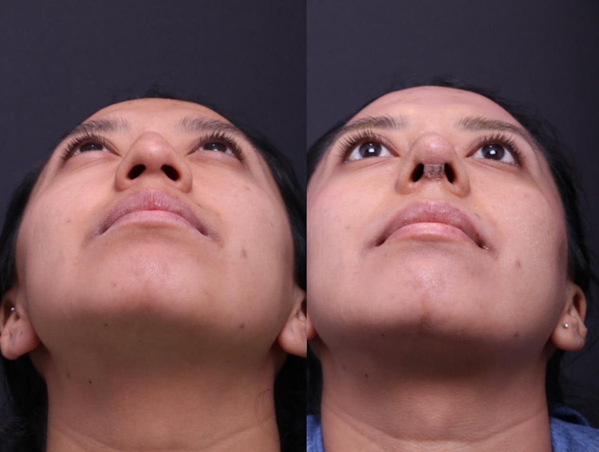 Rhinoplasty Before & After Gallery - Patient 372630 - Image 7