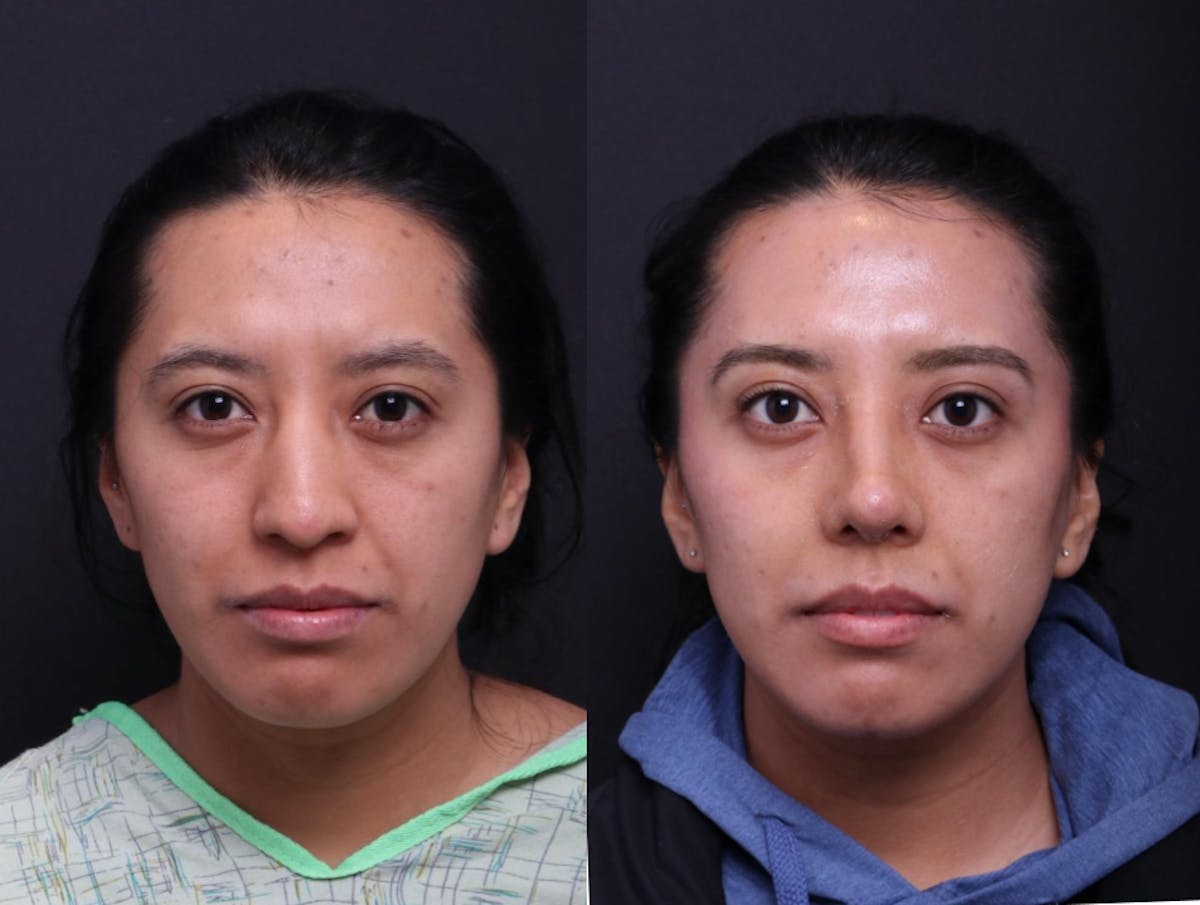 Rhinoplasty Before & After Gallery - Patient 372630 - Image 1
