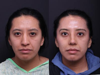 Rhinoplasty Before & After Gallery - Patient 372630 - Image 1
