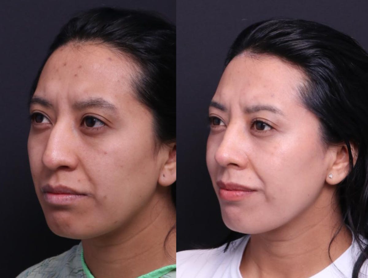 Rhinoplasty Before & After Gallery - Patient 248374 - Image 6
