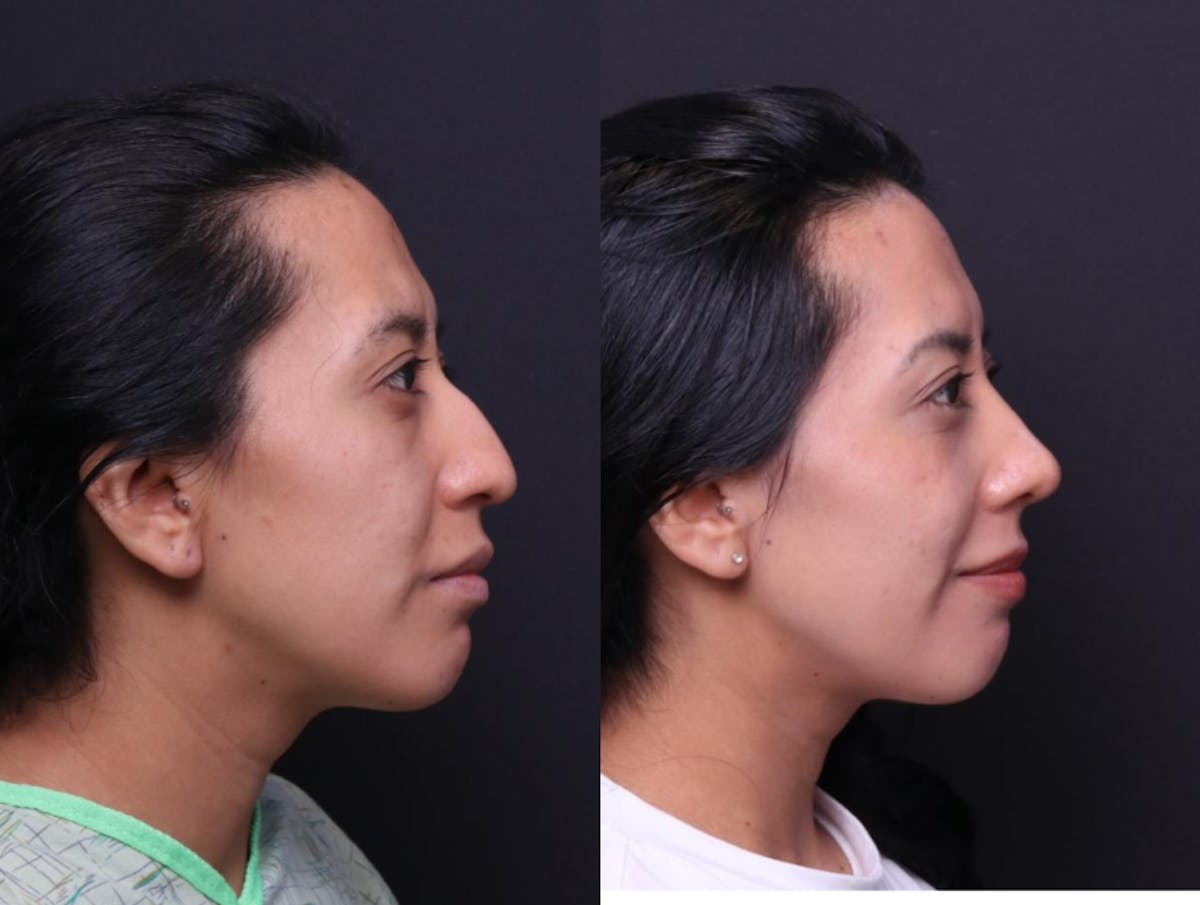 Rhinoplasty Before & After Gallery - Patient 248374 - Image 4