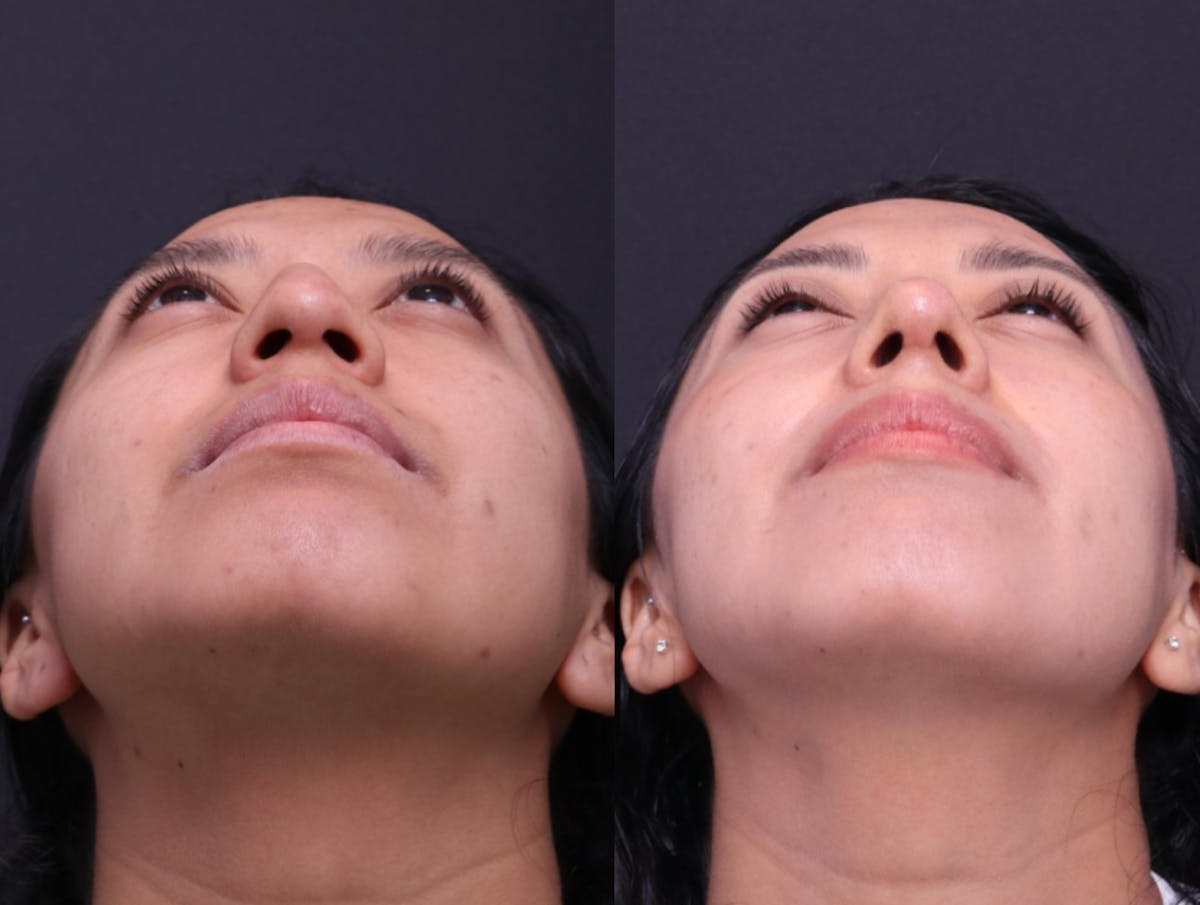 Rhinoplasty Before & After Gallery - Patient 248374 - Image 7