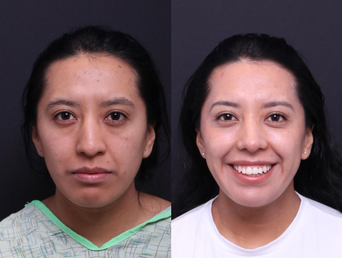 Rhinoplasty Before & After Gallery - Patient 248374 - Image 1