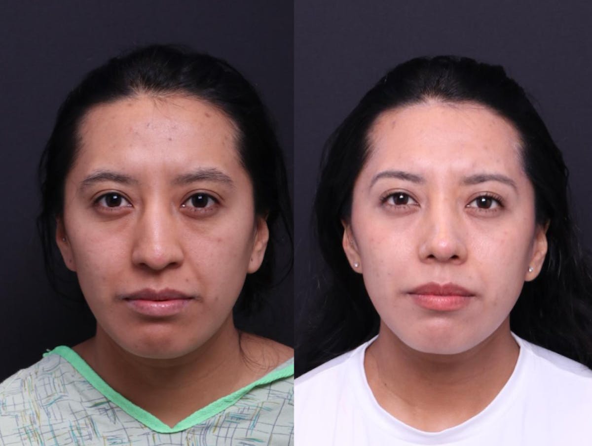 Rhinoplasty Before & After Gallery - Patient 248374 - Image 2