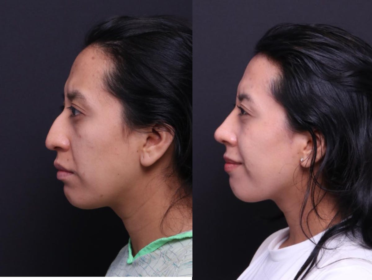 Rhinoplasty Before & After Gallery - Patient 248374 - Image 5