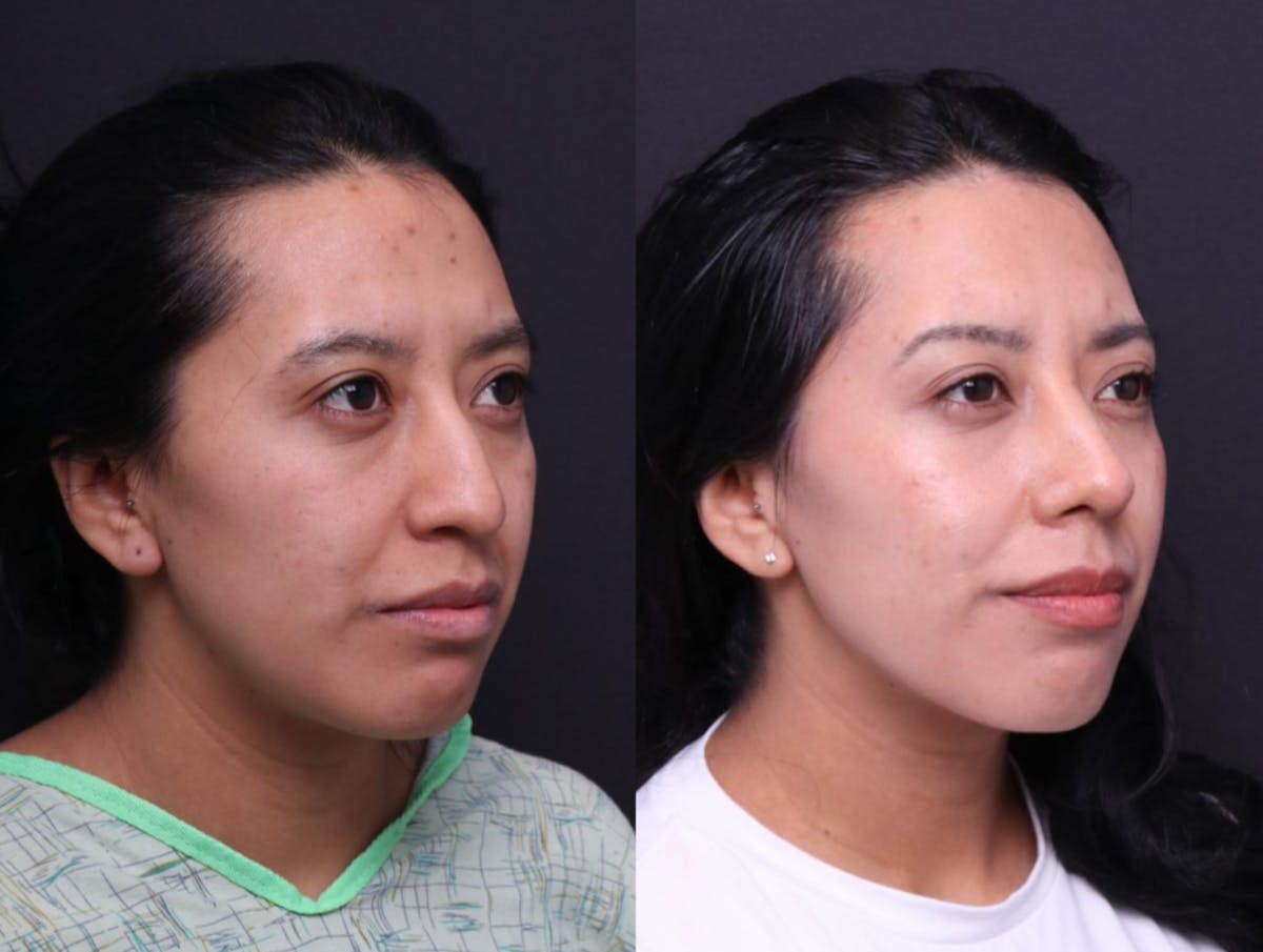Rhinoplasty Before & After Gallery - Patient 248374 - Image 3