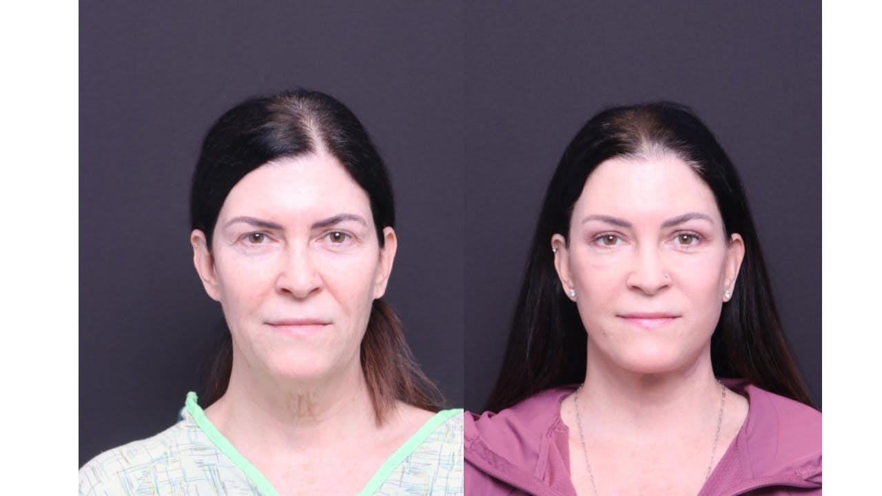 Neck Lift Before & After Gallery - Patient 318717 - Image 1