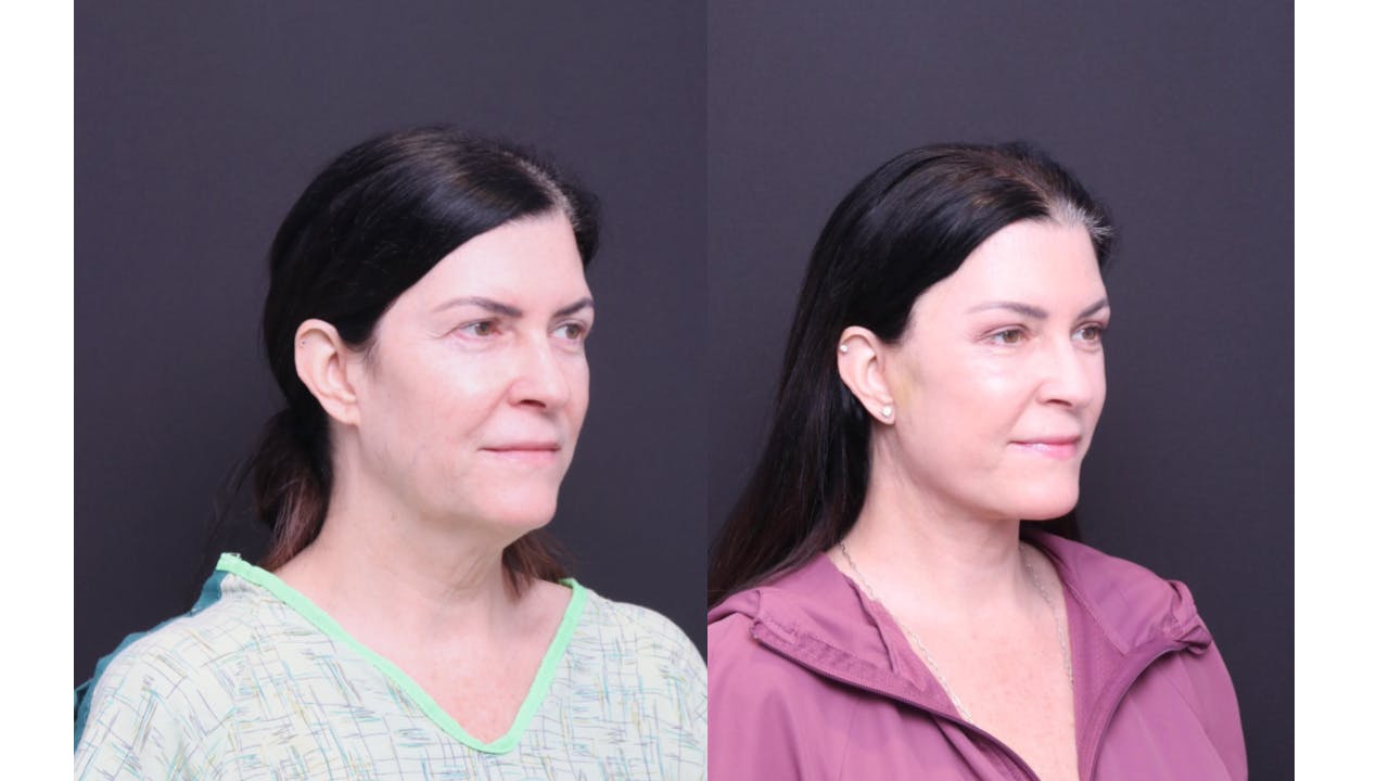 Neck Lift Before & After Gallery - Patient 318717 - Image 2